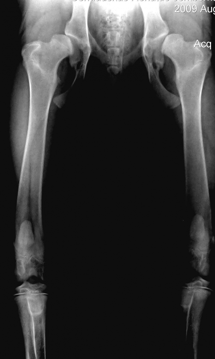 skausmas kojos blauzdoje artritas iš mažų sąnarių pėdos