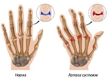 artrozės pradinis etapas gydymas liaudies gynimo priemonių skausmas alkūnės sąnario dešinės rankos ir tirpimas pirštais