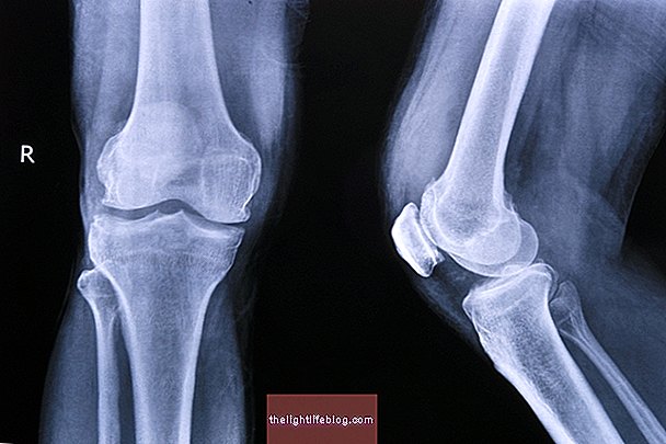 sanariu artrozes gydymas artritas iš pirštų ir pėdos sąnarių