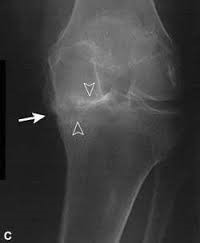artrozė iš spindulių-tailed sąnarių 2 etapai yazis gydymas sąnarių