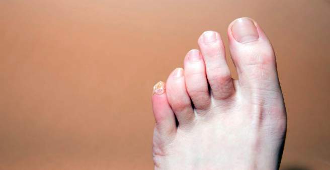 šis mažas pėdos pėdos artritas gydymas įrenginių smulkius sąnarius