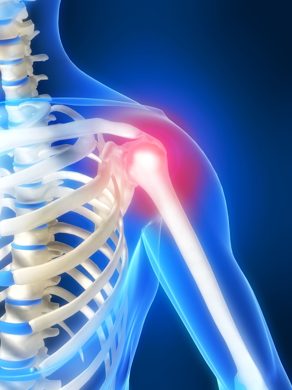 kaulų skausmas peties sąnarys etape artrozės keičiasi sąnarį