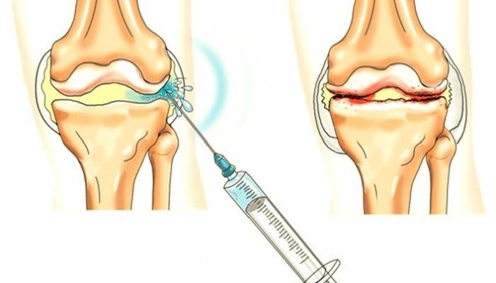 osteoartrozė nuo alkūnės jungties 2 laipsnių gydymo sąnarių skausmas su rotaviruso
