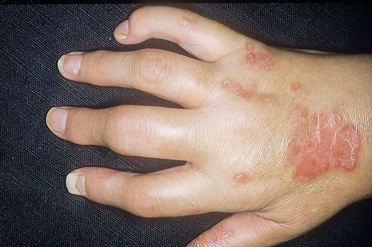 skausmas ir sąnarių kai nuspaudžiant nervų reumatoidinis artritas rankų vyrams