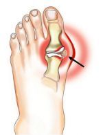 skausmas rankų ir pėdų sąnarių sanariu gydymas lazeriu vilniuje
