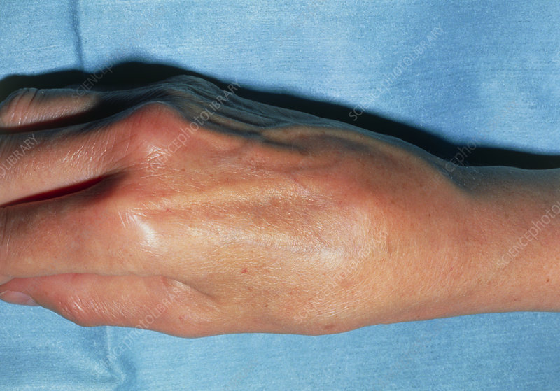 swelling joints in wrist ką gerti skausmas šepečiai sąnarių